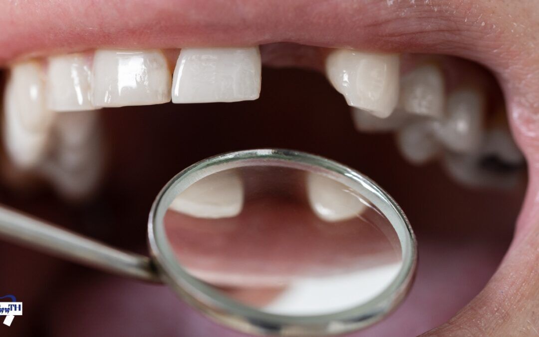 Missing Lateral Teeth